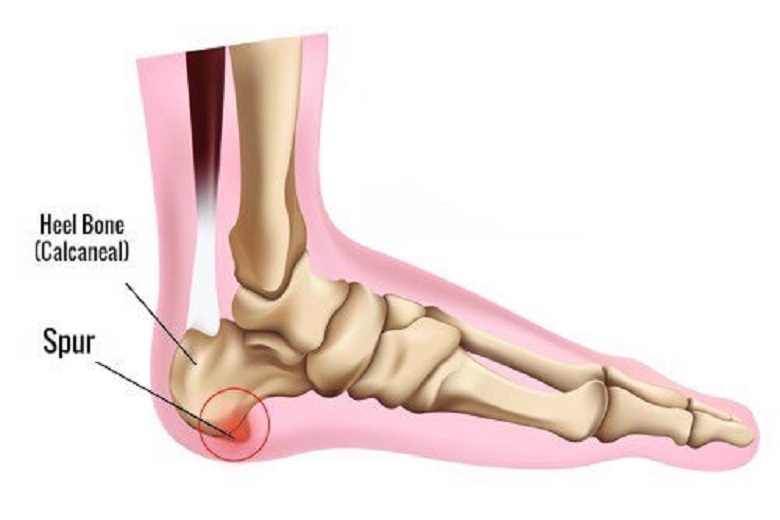 درد در پاشنه پا